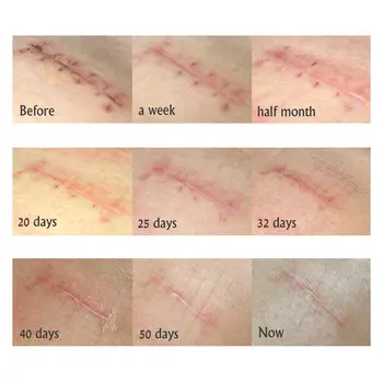 ARTISCARE Acne Scar Removal Cream Koža Popravila Obraz, Krema za Akne Vložki Zdravljenje Aken Blackhead Kreme za Beljenje Strij, 30 ml