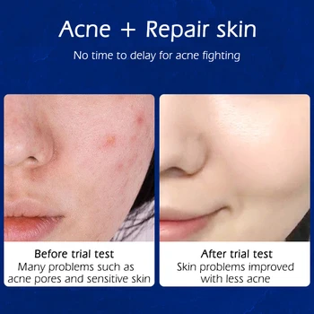 SENANA Blage Akne Odstranitev Facial Cream Aloe Vera, Zdravljenje Aken, Reparing Olje Nadzor Vlažilne Obraz Vlažilna Nega Kože
