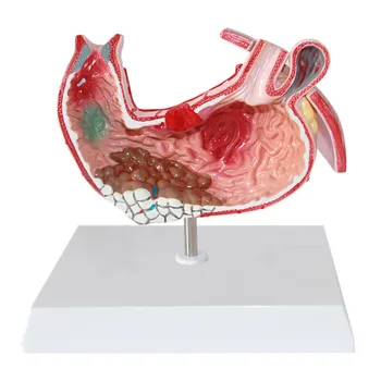 Želodčne Bolezni Predstavitvene Želodec Patološkega Model Anatomijo Medicinske Potrebščine