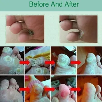 12 ur Wart Zdravljenje Papillomas odstranjevanju Bradavice Tekočine Iz Kože Tags Odstranjevanje Proti Moli za odstranjevanje barve Anti Verruca Sredstvo